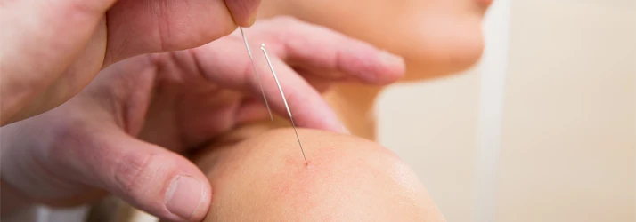 Chiropractic Leland NC Dry Needling